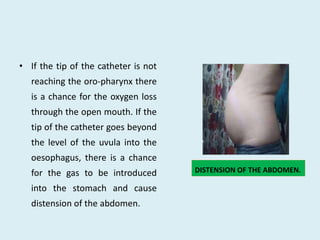 • If the tip of the catheter is not
reaching the oro-pharynx there
is a chance for the oxygen loss
through the open mouth. If the
tip of the catheter goes beyond
the level of the uvula into the
oesophagus, there is a chance
for the gas to be introduced
into the stomach and cause
distension of the abdomen.
DISTENSION OF THE ABDOMEN.
 
