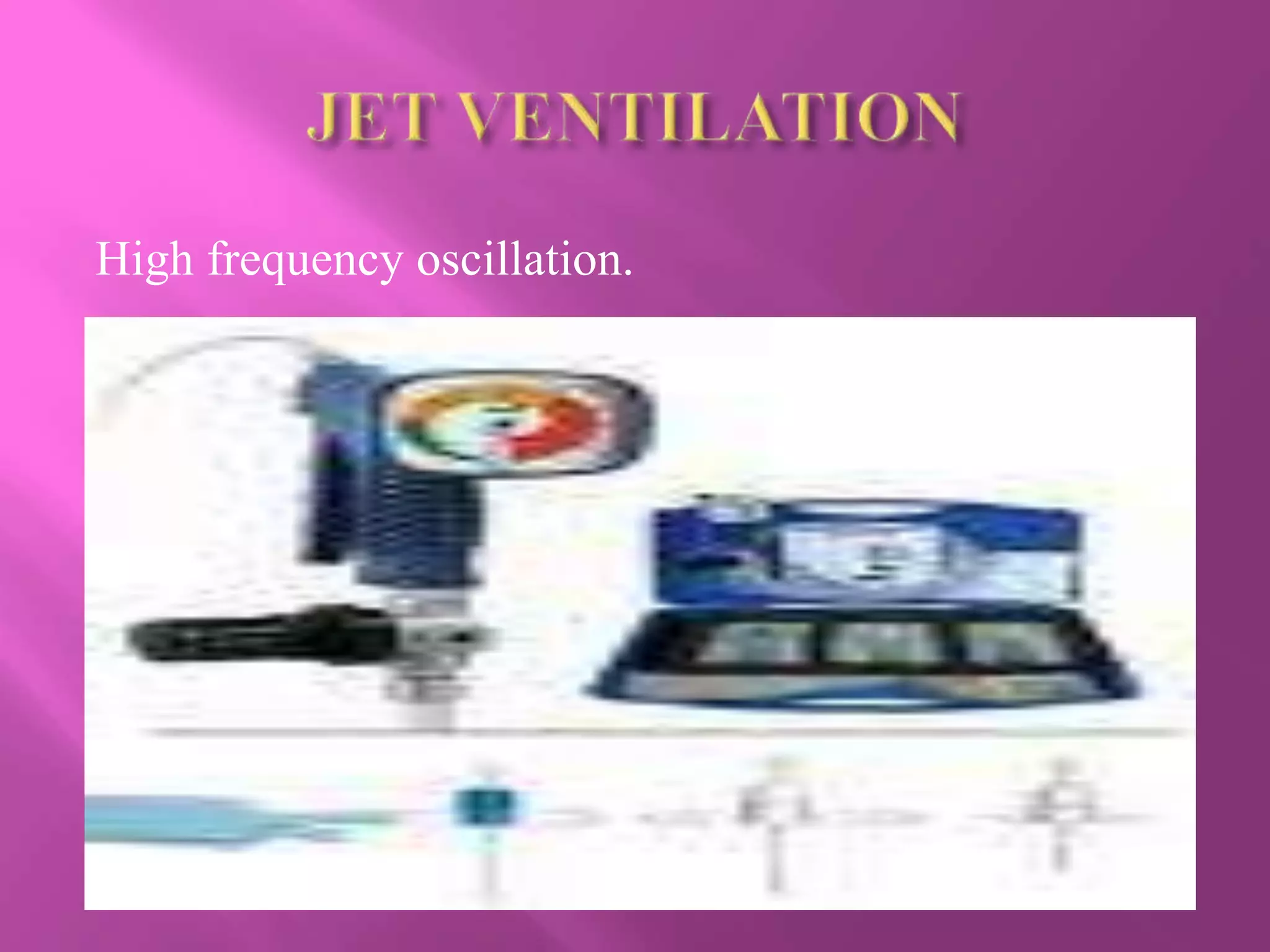 High frequency oscillation.
 