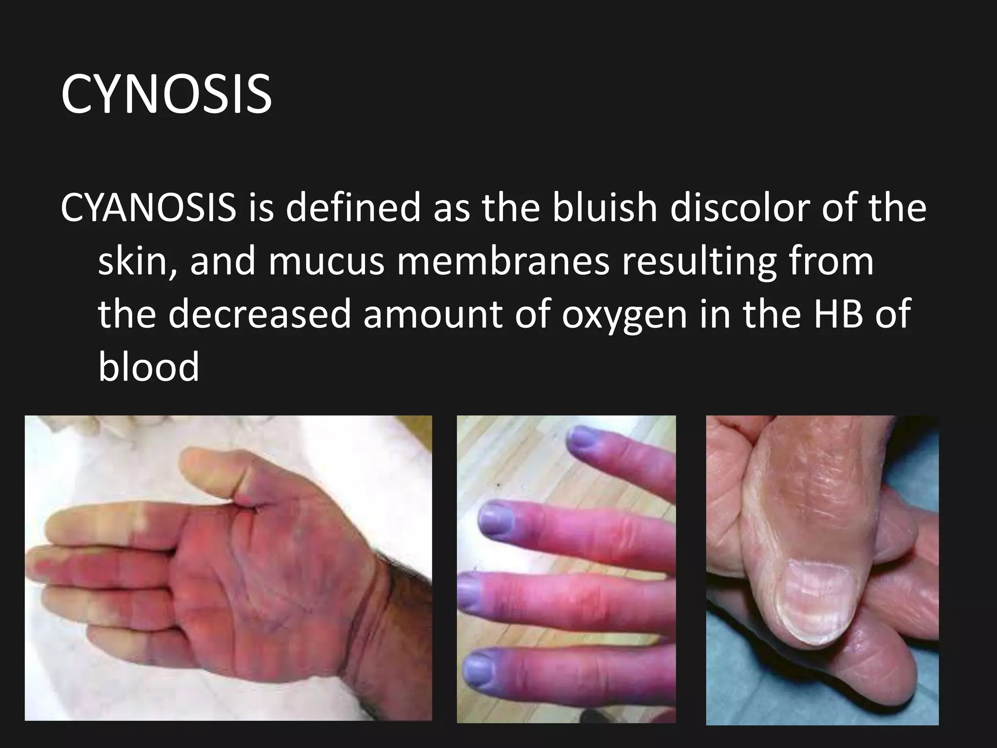 CYNOSIS
CYANOSIS is defined as the bluish discolor of the
skin, and mucus membranes resulting from
the decreased amount of oxygen in the HB of
blood
 