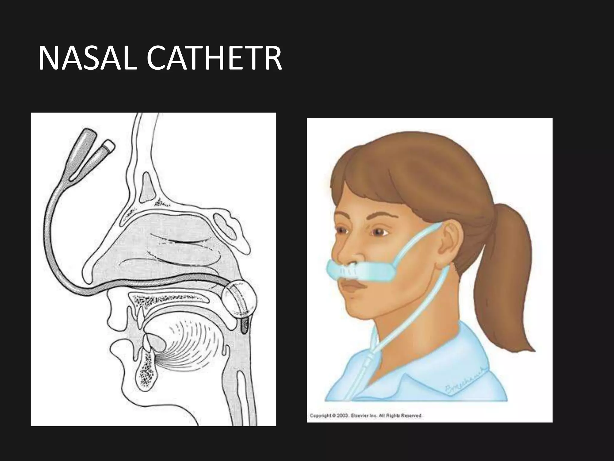 NASAL CATHETR
 