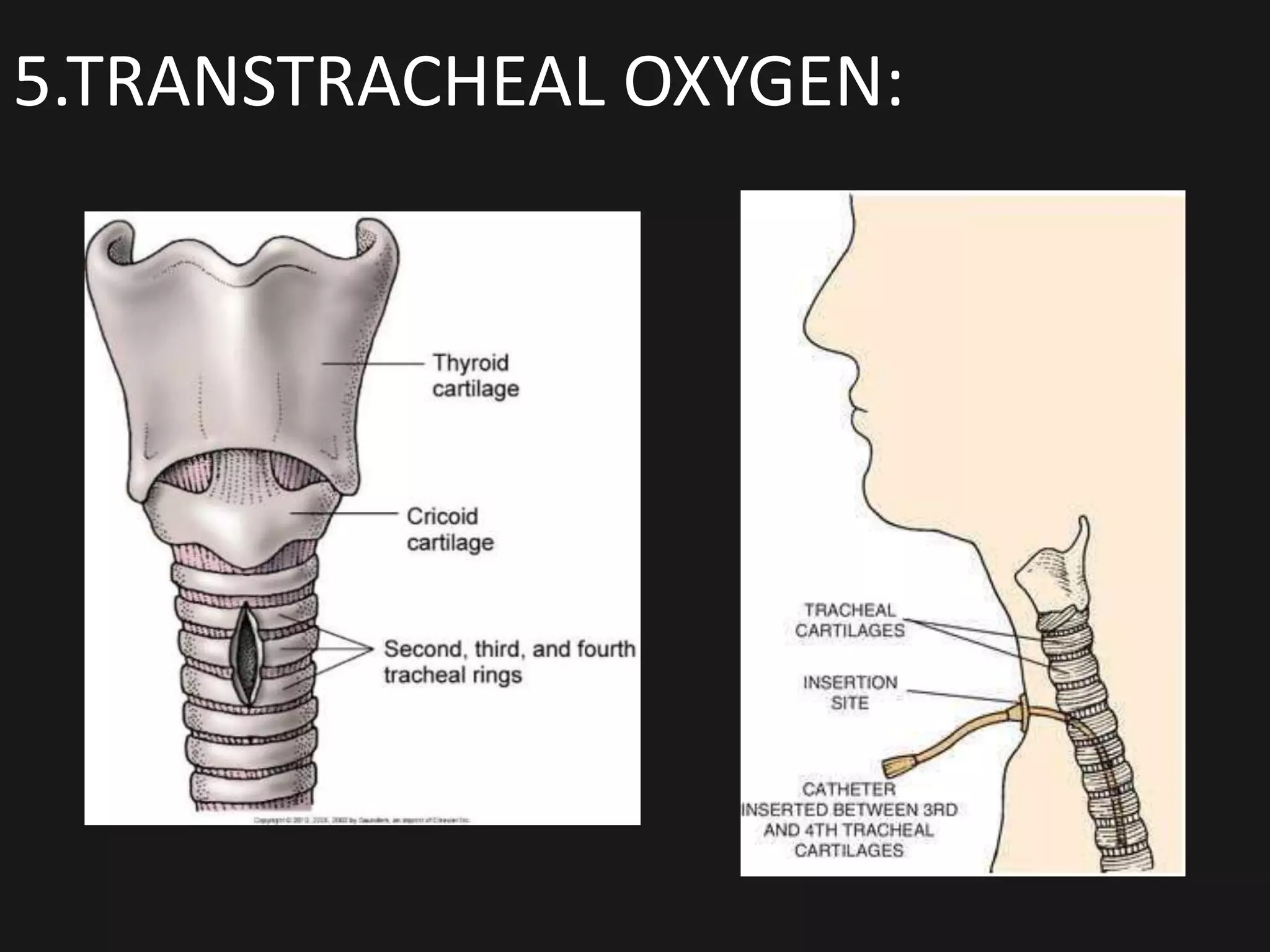 5.TRANSTRACHEAL OXYGEN:
 