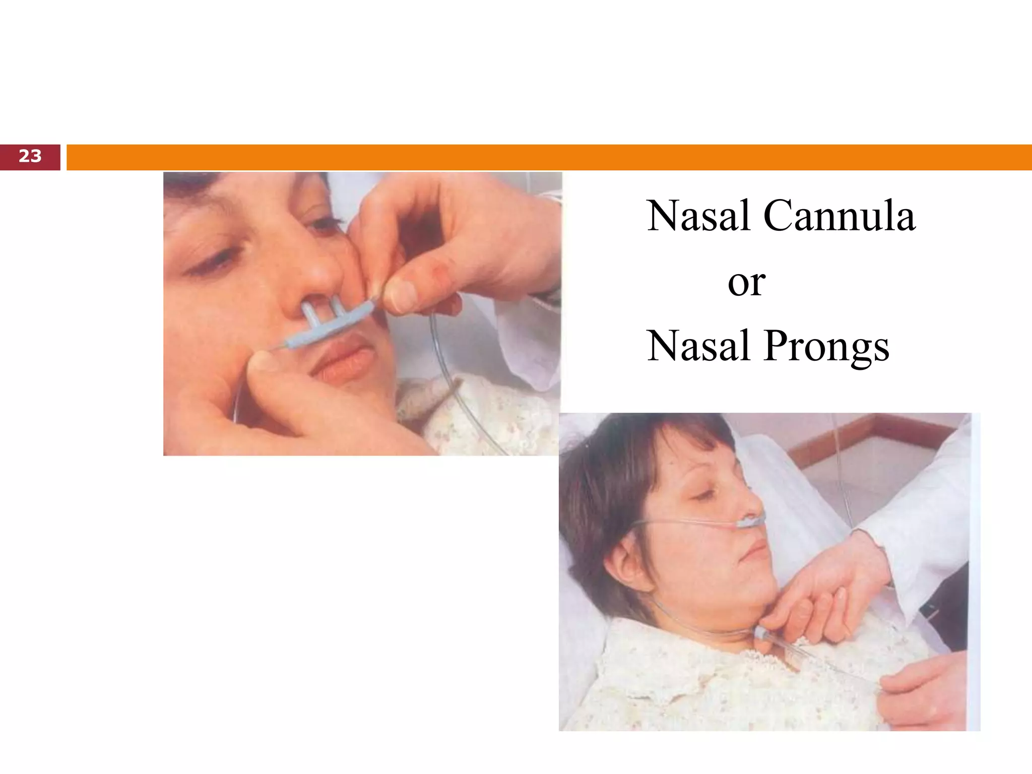 Nasal Cannula
or
Nasal Prongs
23
 
