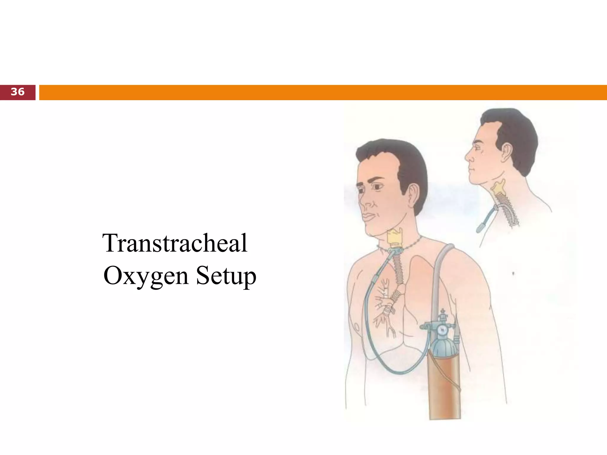 Transtracheal
Oxygen Setup
36
 