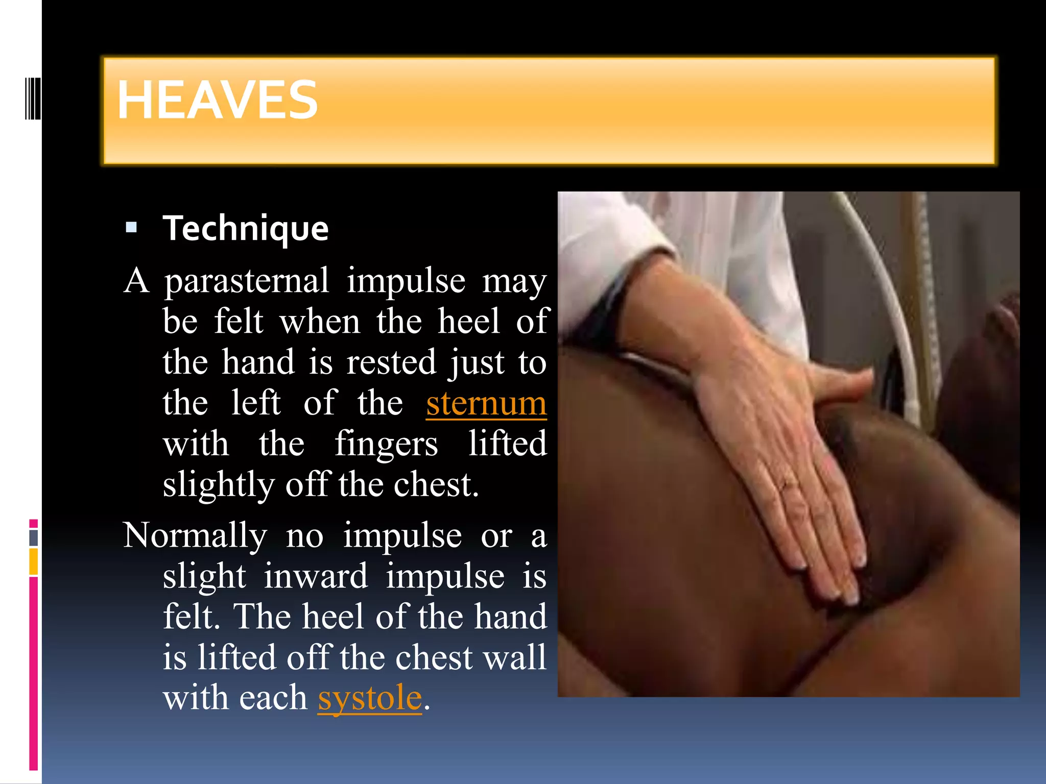 HEAVES 
 Technique 
A parasternal impulse may 
be felt when the heel of 
the hand is rested just to 
the left of the sternum 
with the fingers lifted 
slightly off the chest. 
Normally no impulse or a 
slight inward impulse is 
felt. The heel of the hand 
is lifted off the chest wall 
with each systole. 
 