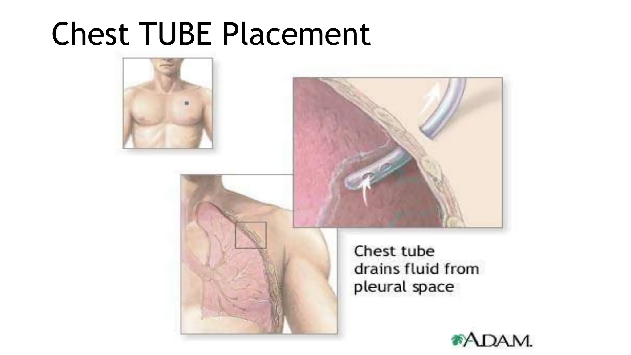 Chest TUBE Placement
 