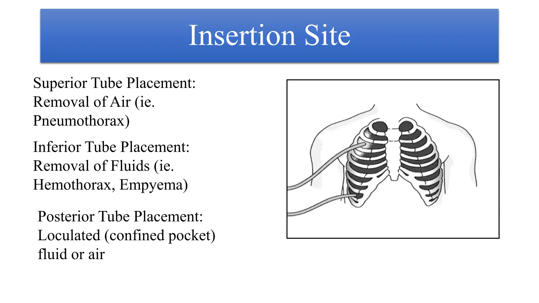 Insertion Site
Superior Tube Placement:
Removal of Air (ie.
Pneumothorax)
Inferior Tube Placement:
Removal of Fluids (ie.
Hemothorax, Empyema)
Posterior Tube Placement:
Loculated (confined pocket)
fluid or air
 