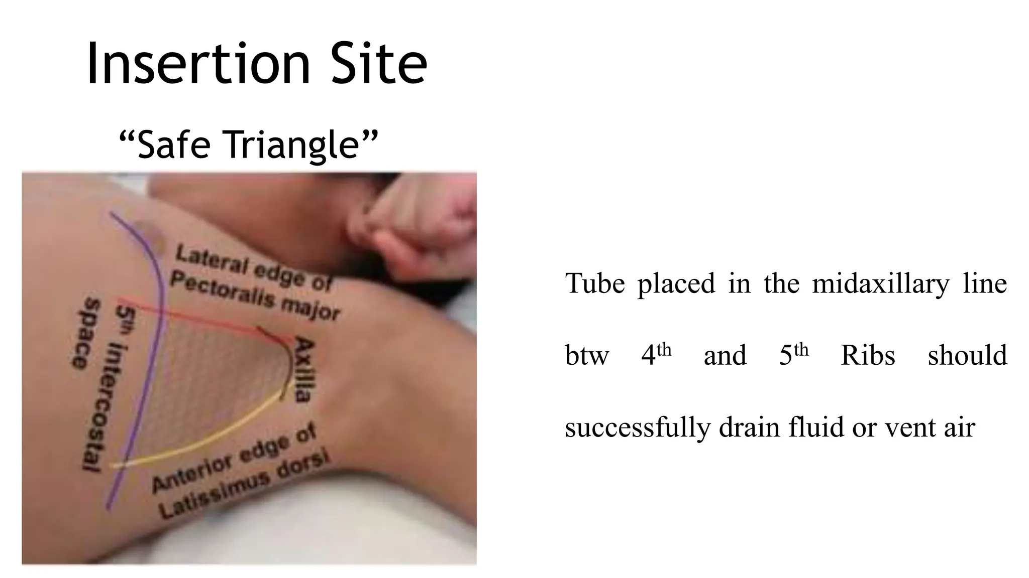 Insertion Site
“Safe Triangle”
Tube placed in the midaxillary line
btw 4th and 5th Ribs should
successfully drain fluid or vent air
 
