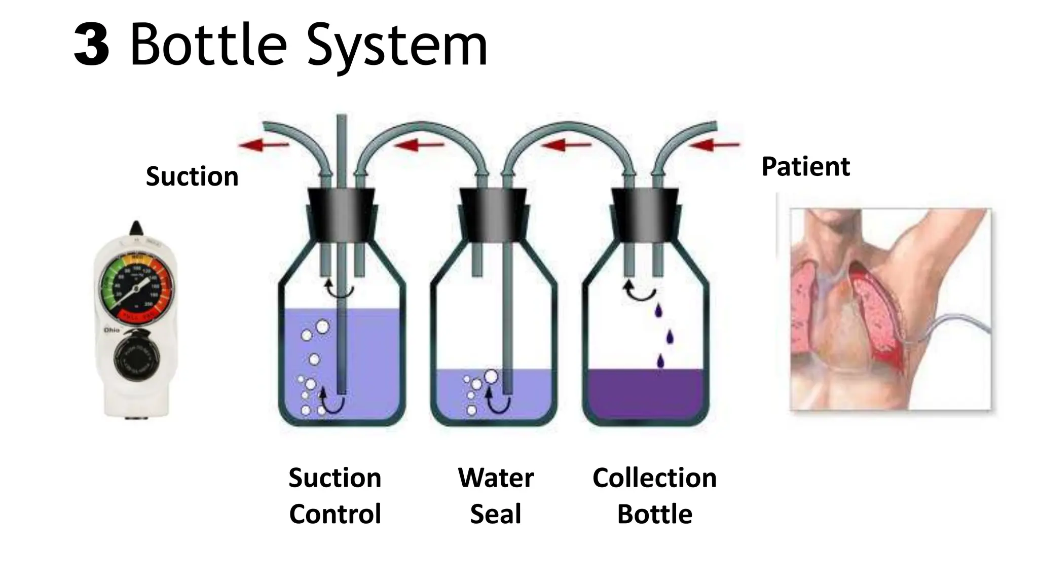 3 Bottle System
Patient
Suction
Collection
Bottle
Water
Seal
Suction
Control
 