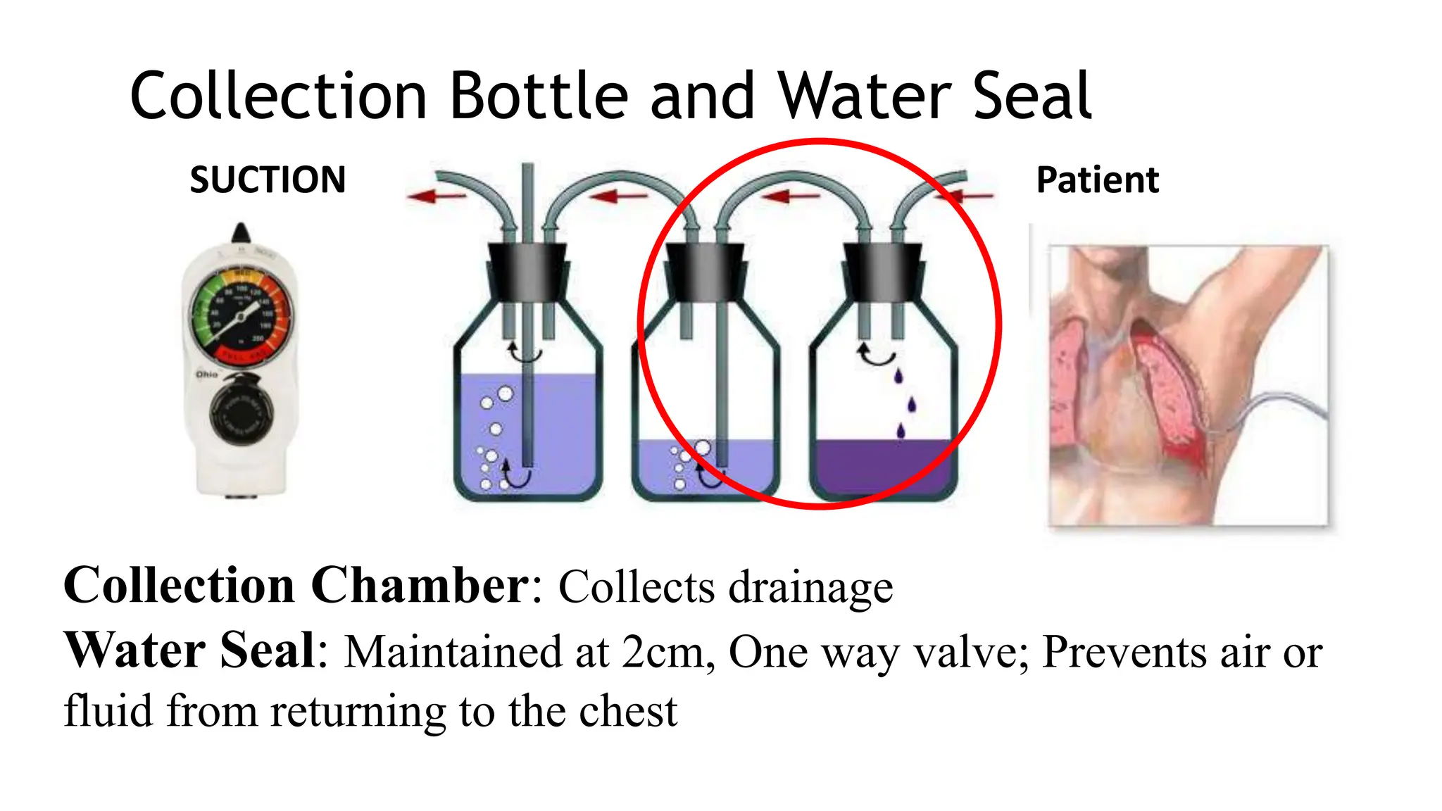 Collection Bottle and Water Seal
Collection Chamber: Collects drainage
Water Seal: Maintained at 2cm, One way valve; Prevents air or
fluid from returning to the chest
Patient
SUCTION
 