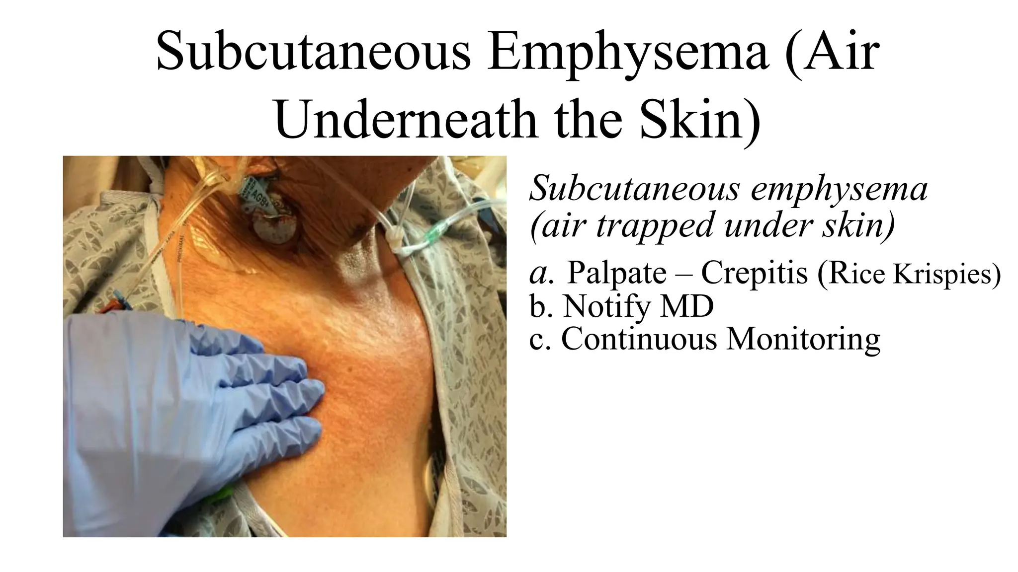 Subcutaneous Emphysema (Air
Underneath the Skin)
Subcutaneous emphysema
(air trapped under skin)
a. Palpate – Crepitis (Rice Krispies)
b. Notify MD
c. Continuous Monitoring
 