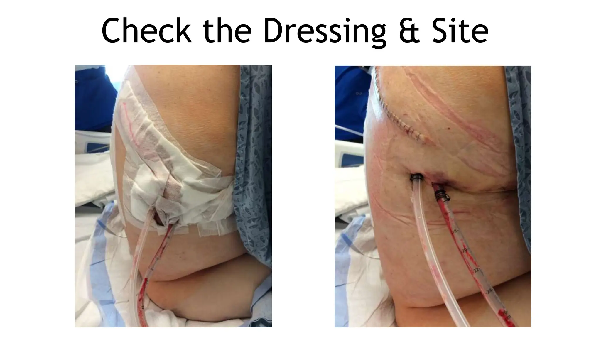 Check the Dressing & Site
 