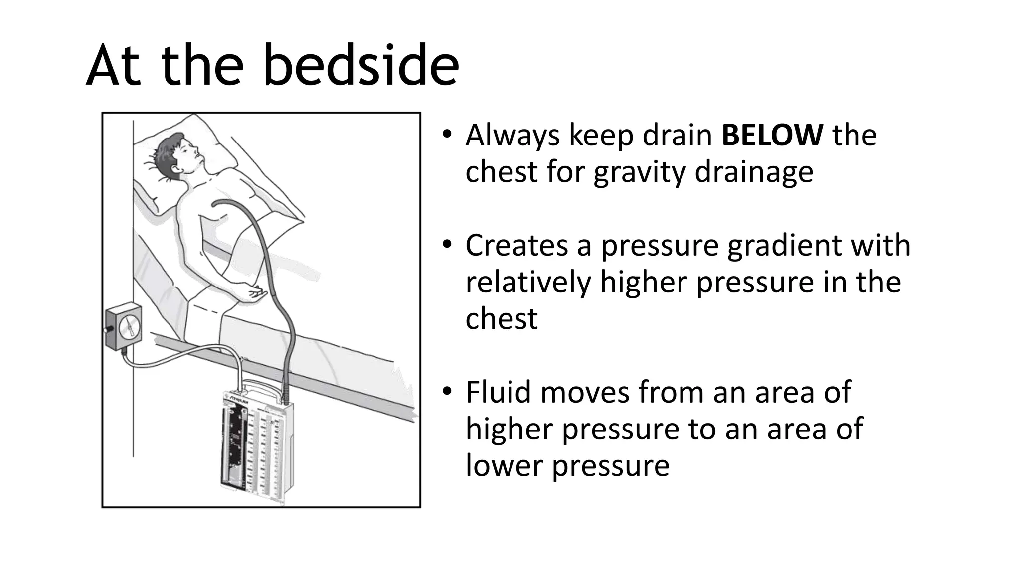 At the bedside
• Always keep drain BELOW the
chest for gravity drainage
• Creates a pressure gradient with
relatively higher pressure in the
chest
• Fluid moves from an area of
higher pressure to an area of
lower pressure
 