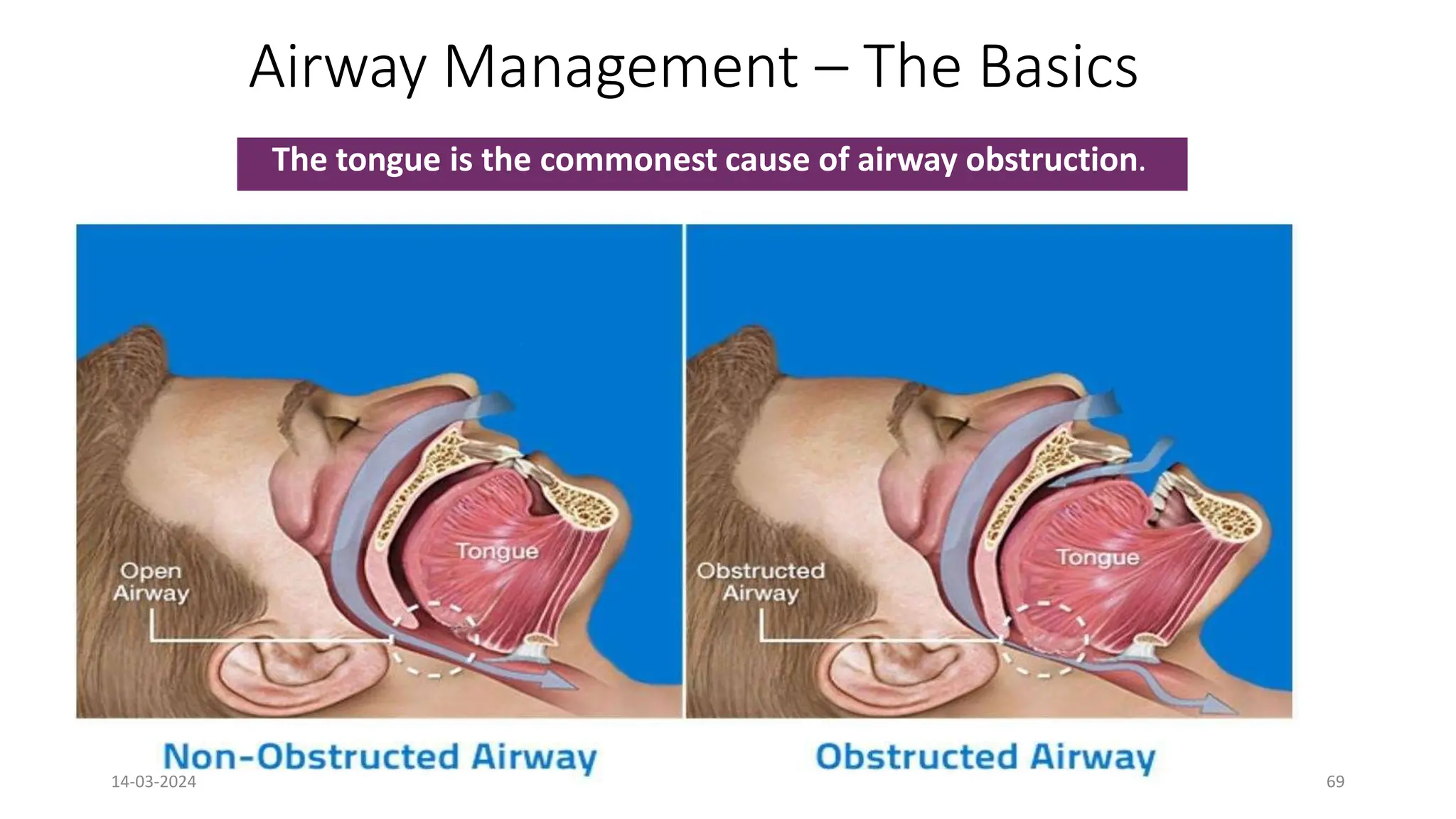 Airway Management – The Basics
The tongue is the commonest cause of airway obstruction.
69
14-03-2024 69
 