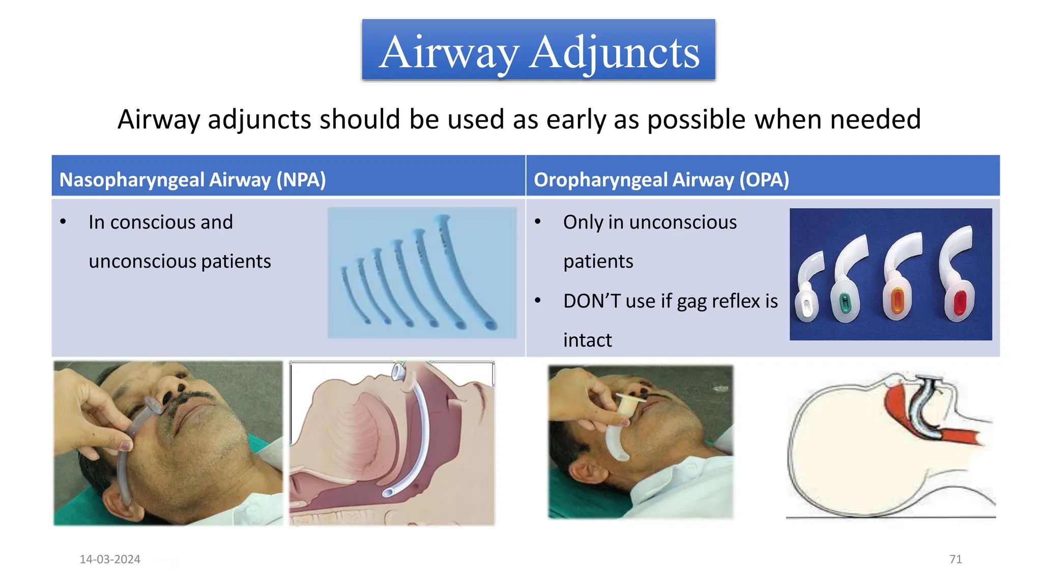 Airway Adjuncts
Airway adjuncts should be used as early as possible when needed
Nasopharyngeal Airway (NPA) Oropharyngeal Airway (OPA)
• In conscious and
unconscious patients
• Only in unconscious
patients
• DON’T use if gag reflex is
intact
14-03-2024 71
 