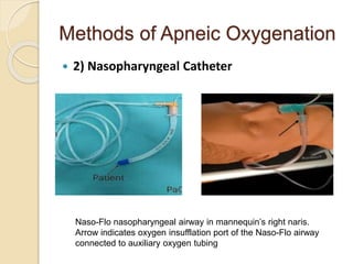 Methods of Apneic Oxygenation
 2) Nasopharyngeal Catheter
Naso-Flo nasopharyngeal airway in mannequin’s right naris.
Arrow indicates oxygen insufflation port of the Naso-Flo airway
connected to auxiliary oxygen tubing
 