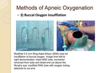 Methods of Apneic Oxygenation
 3) Buccal Oxygen Insufflation
Modified 3.5 mm Ring-Adair-Elwyn (RAE) tube for
insufflation of buccal oxygen. Image from left to
right demonstrates: intact RAE tube; connector
removed from tube and distal end cut above the
Murphy eye; modified RAE tube with oxygen tubing
attached to cut end.
 