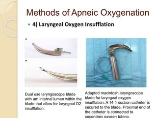 Methods of Apneic Oxygenation
 4) Laryngeal Oxygen Insufflation
Dual use laryngoscope blade
with am internal lumen within the
blade that allow for laryngeal O2
insufflation.
Adapted macintosh laryngoscope
blade for laryngeal oxygen
insufflation. A 14 fr suction catheter is
secured to the blade. Proximal end of
the catheter is connected to
secondary oxygen tubing.
 