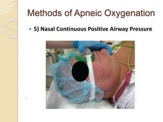 Methods of Apneic Oxygenation
 5) Nasal Continuous Positive Airway Pressure
.
 