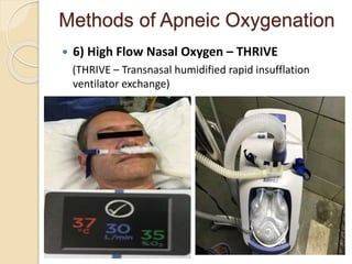 Methods of Apneic Oxygenation
 6) High Flow Nasal Oxygen – THRIVE
(THRIVE – Transnasal humidified rapid insufflation
ventilator exchange)
.
 