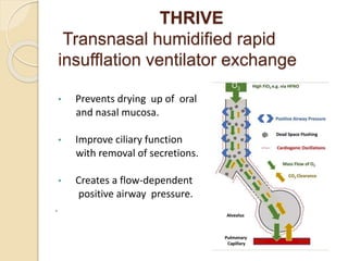 THRIVE
Transnasal humidified rapid
insufflation ventilator exchange
• Prevents drying up of oral
and nasal mucosa.
• Improve ciliary function
with removal of secretions.
• Creates a flow-dependent
positive airway pressure.
.
 