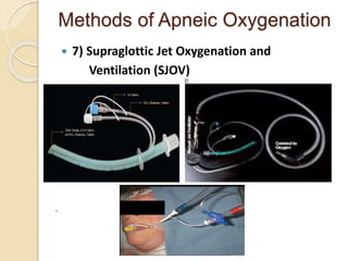 Methods of Apneic Oxygenation
 7) Supraglottic Jet Oxygenation and
Ventilation (SJOV)
.
 