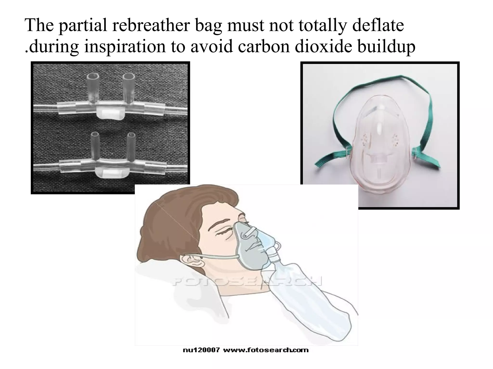 The partial rebreather bag must not totally deflate
during inspiration to avoid carbon dioxide buildup
.
 