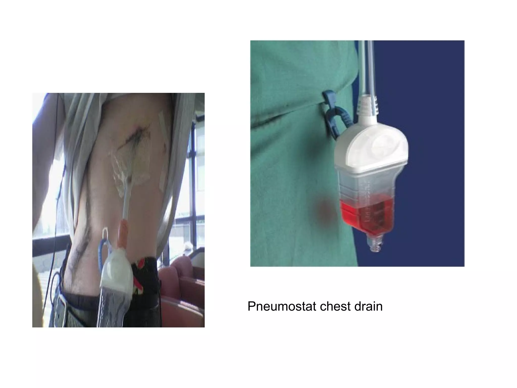 Pneumostat chest drain
 