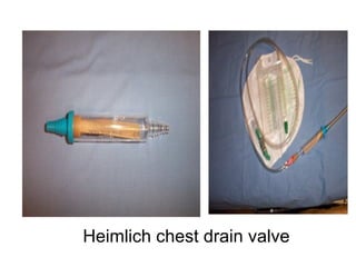 Heimlich chest drain valve
 