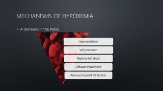 •
Hypoventilation
V/Q mismatch
Right-to-left shunt
Diffusion impairment
Reduced inspired O2 tension
 