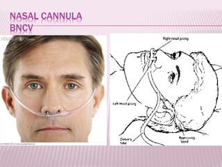 NASAL CANNULA
BNCV
 
