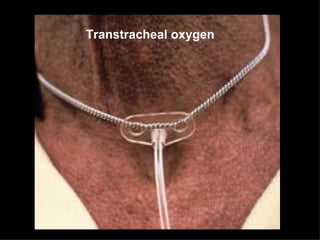 Transtracheal oxygen
 