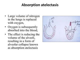 Absorption atelectasis
• Large volume of nitrogen
in the lungs is replaced
with oxygen,
• Oxygen is subsequently
absorbed into the blood,
• The effect is reducing the
volume of the alveoli,
resulting in a form of
alveolar collapse known
as absorption atelectasis
 