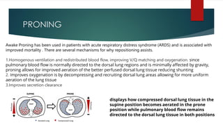 PRONING
displays how compressed dorsal lung tissue in the
supine position becomes aerated in the prone
position while pulmonary blood flow remains
directed to the dorsal lung tissue in both positions
Awake Proning has been used in patients with acute respiratory distress syndrome (ARDS) and is associated with
improved mortality . There are several mechanisms for why repositioning assists.
1.Homogenous ventilation and redistributed blood flow, improving V/Q matching and oxygenation. since
pulmonary blood flow is normally directed to the dorsal lung regions and is minimally affected by gravity,
proning allows for improved aeration of the better perfused dorsal lung tissue reducing shunting
2. Improves oxygenation is by decompressing and recruiting dorsal lung areas allowing for more uniform
aeration of the lung tissue
3.Improves secretion clearance
 
