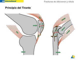 fracturas-de-ol-cranon-y-r-tula-pdf
