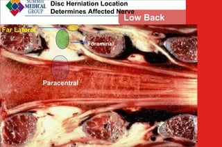 Disc Herniation Location
Determines Affected Nerve

Low Back
Pain

Far Lateral
Foraminal

Paracentral

 