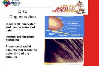 Disc
Degeneration
Discs well innervated
and can be source of
pain
Internal architecture
disrupted
Presence of radial
fissures that reach the
outer third of the
annulus

Low Back
Pain

 