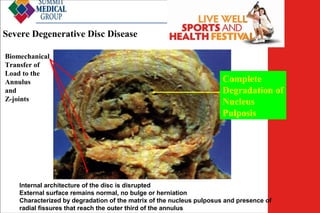 Severe Degenerative Disc Disease
Biomechanical
Transfer of
Load to the
Annulus
and
Z-joints

Low Back
Pain
Complete
Degradation of
Nucleus
Pulposis

Internal architecture of the disc is disrupted
External surface remains normal, no bulge or herniation
Characterized by degradation of the matrix of the nucleus pulposus and presence of
radial fissures that reach the outer third of the annulus

 