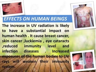 EFFECTS ON HUMAN BEINGS
The increase in UV radiation is likely
to have a substantial impact on
human health . It cause breast cancer,
skin cancer ,luckiemia , eye cataracts
,reduced immunity level and
infection diseases . Increased
exposures of the human bodies to UV
rays will weaken their immunity
system.
 