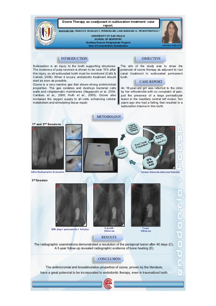Ozone therapy in endodontic treatment