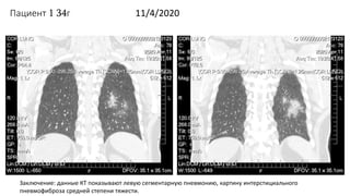 Пациент 1 34г 11/4/2020
Заключение: данные КТ показывают левую сегментарную пневмонию, картину интерстициального
пневмофиб...