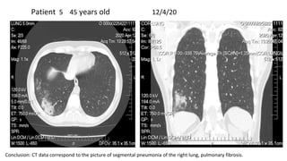 Patient 5 45 years old 12/4/20
Conclusion: CT data correspond to the picture of segmental pneumonia of the right lung, pul...