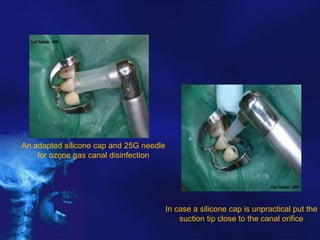 An adapted silicone cap and 25G needle
for ozone gas canal disinfection

In case a silicone cap is unpractical put the
suction tip close to the canal orifice

 
