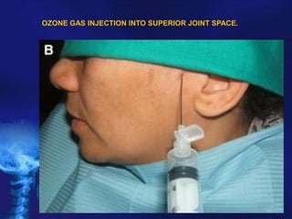 OZONE GAS INJECTION INTO SUPERIOR JOINT SPACE.

 