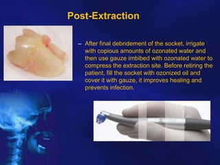 Post-Extraction
– After final debridement of the socket, irrigate
with copious amounts of ozonated water and
then use gauze imbibed with ozonated water to
compress the extraction site. Before retiring the
patient, fill the socket with ozonized oil and
cover it with gauze, it improves healing and
prevents infection.

 