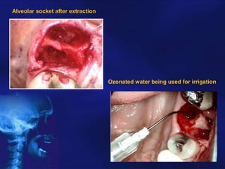 Alveolar socket after extraction

Ozonated water being used for irrigation

 