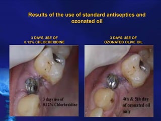 Results of the use of standard antiseptics and
ozonated oil
3 DAYS USE OF
0.12% CHLOEHEXIDINE

3 DAYS USE OF
OZONATED OLIVE OIL

 
