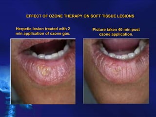 EFFECT OF OZONE THERAPY ON SOFT TISSUE LESIONS
Herpetic lesion treated with 2
min application of ozone gas.

Picture taken 40 min post
ozone application.

 