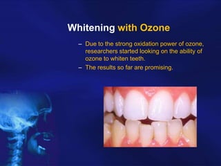 Whitening with Ozone
– Due to the strong oxidation power of ozone,
researchers started looking on the ability of
ozone to whiten teeth.
– The results so far are promising.

 