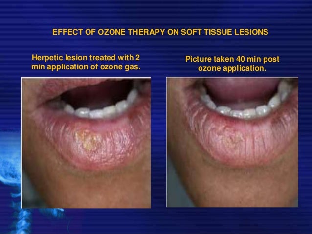 ozone dentistry
