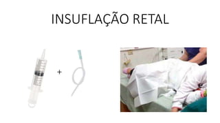 INSUFLAÇÃO RETAL
 